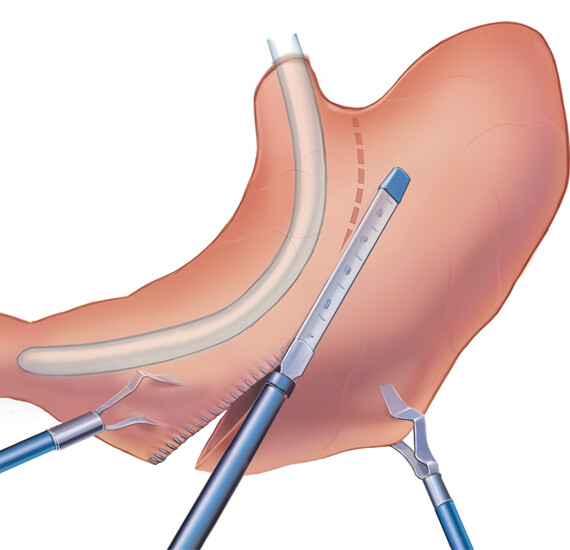 sleeve gastrectomy