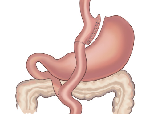 Grafic picture Gastric bypass