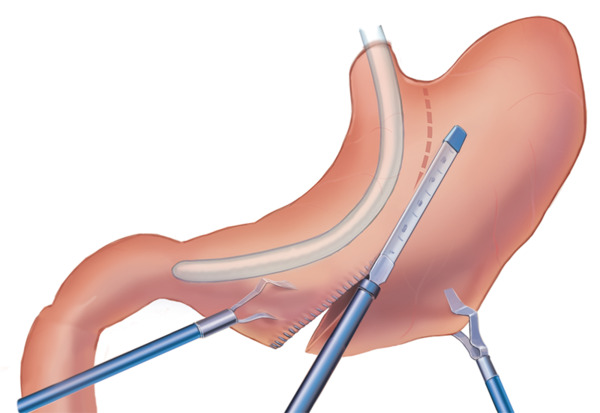 Sleeve gastrectomy